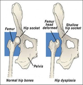 Hip socket depth