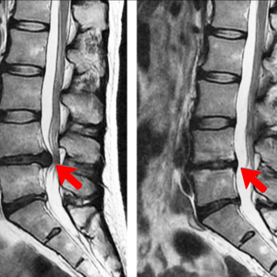 MRI image showing a comparison of an active disc bulge vs the bulge having healed.