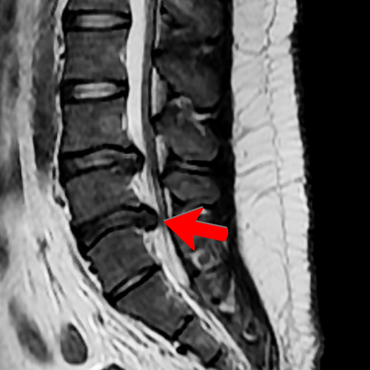 MRI image of a disc herniation at L4-L5