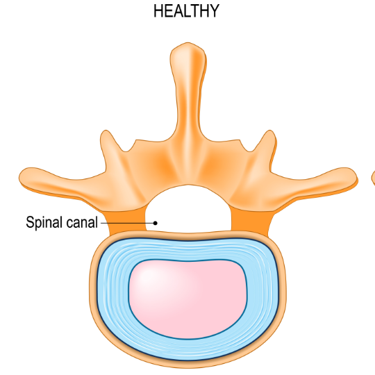 Simplified medical diagram of a healthy vertebra with a healthy spinal canal.