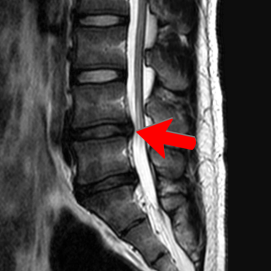MRI image of the lumbar spine, showing disc bulges at L4-L5 and L5-S1.