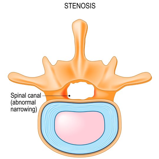 Diagram of a vertebra with a  stenotic spinal canal. 