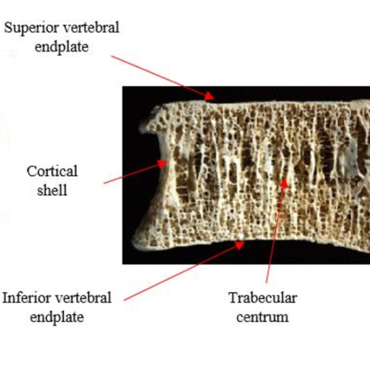 Photo of a lumbar vertebra cut vertically to expose the inner structure.