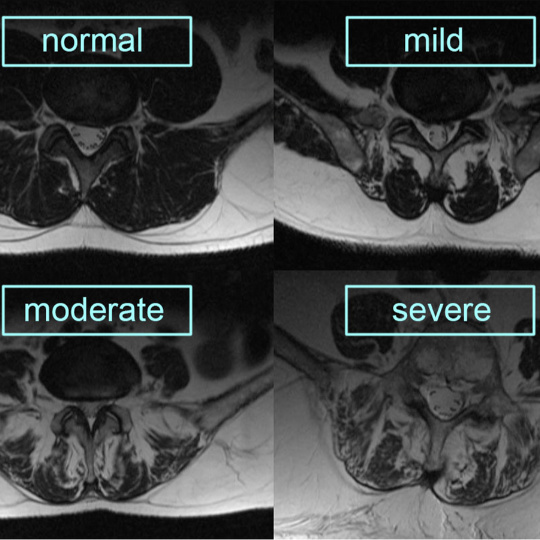 MRI images showing different stages of fatty infiltration of the lumber multifidus.
Shows a progression through 4 stages from normal, mild, moderate to severe.