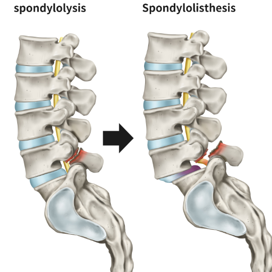 Diagram showing a progression from spondylolysis to spondylolisthesis.