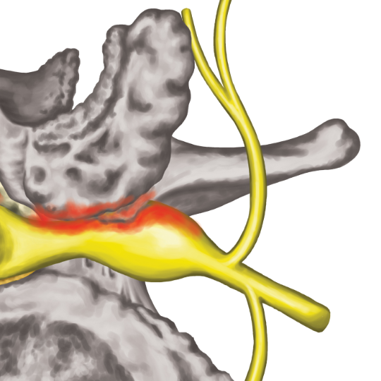 diagram of foraminal stenosis, showing impingement upon the sciatic nerve root.
