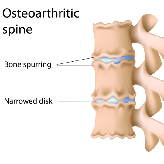 Diagram of an osteoarthritic spine showing signs of spondylosis.